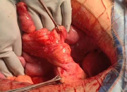 Laparoscopic Reoperative Ileal J Pouch Anal Anastomosis: A Better Option?