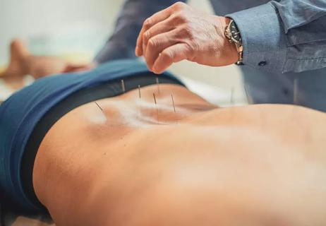 Person getting acupuncture in lower spine area for pain in back.