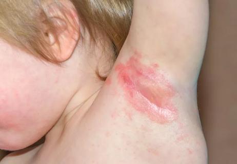 Closeup of a toddler with a yeast infection in their armpit.