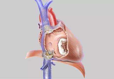 22-HVI-2843464_transcatheter-bicaval-valves-system_650x450