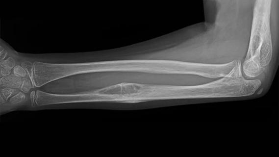 X-ray of a tumor in the bone of a child's arm