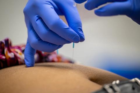 Acupuncture