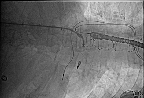 A transcatheter implanted clip improves coaptation of the mitral valve leaflets.