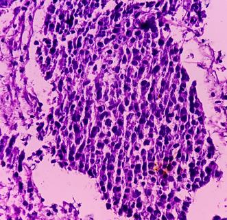 Microscopic view of bladder cancer with variant histology