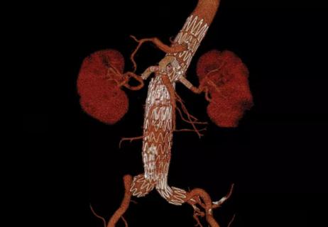 Fixing Failed EVAR: How Do Open and Endovascular Options Stack Up?