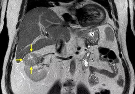 650&#215;450-Robotic-Partial-Nephrectomy