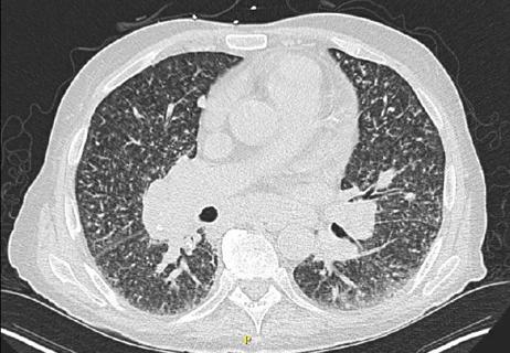 CT of chest