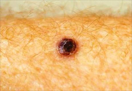 18-CNR-865-tarhiniMelanoma-650&#215;450
