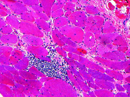 Muscle biopsy slide image showing myositis