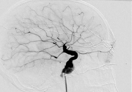 image of human brain with an intracranial aneurysm