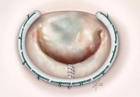 23-HVI-3691658 mitral-valve-repair_650x450