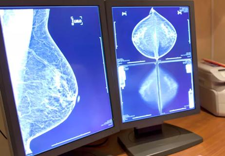 Mammography images on computer screens