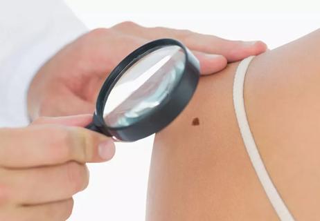 Person getting checked for possible skin cancer at doctor's office.