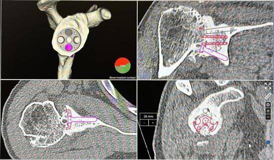 How Augmented Reality Is Reshaping Shoulder Replacement Surgery