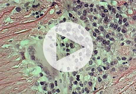 polymyalgia rheumatica and giant cell arteritis