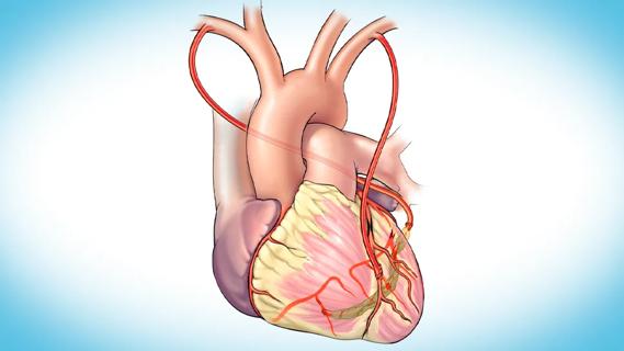 human heart illustration showing coronary bypass grafts