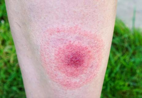 Bullseye-like rash on leg from lyme disease infection