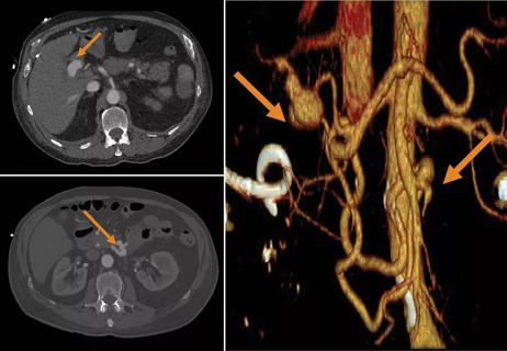 22-RHE-3091670-yaseen-endocarditis-CQD-jk