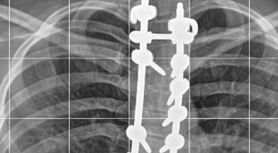 Scoliosis-Hero-Image-690x380pxl