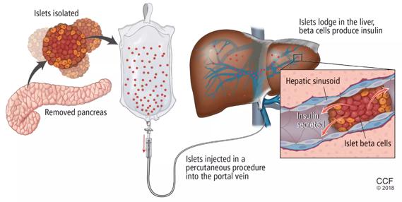 Two Novel Intestinal Transplants Show Cleveland Clinic Program's