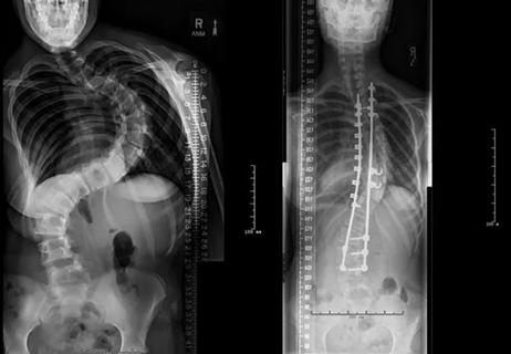 Adolescent idiopathic scoliosis