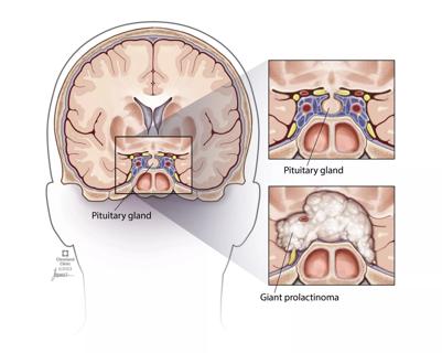 giant prolactinoma