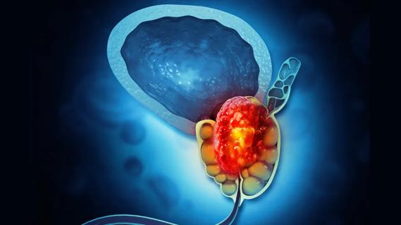 Prostate cancer illustration