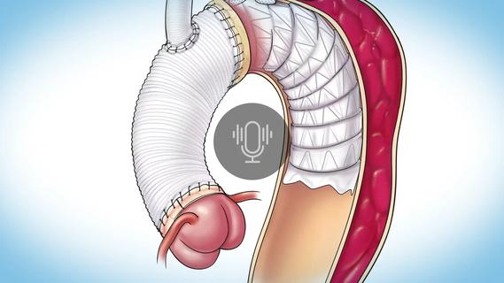 illustration of aortic arch after stent graft repair