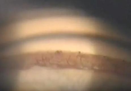 Neovascular glaucoma