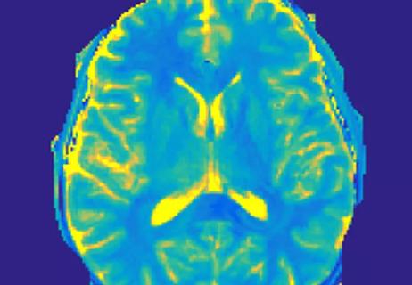 magnetic resonance fingerprinting image of the human brain