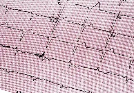 23-HVI-4469361_atrial-fibrillation_650x450