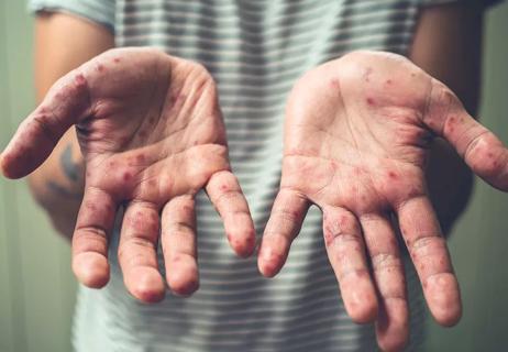 man with Hand foot mouth disease