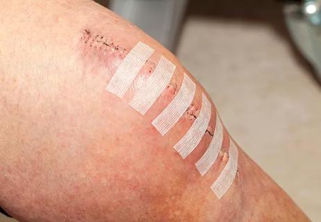 Knee replacement incision