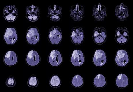 Patient With Stage 4 Triple-Negative Breast Cancer in Remission 10