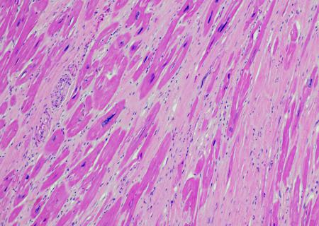 histopathologic image of tissue from a hypertrophied heart