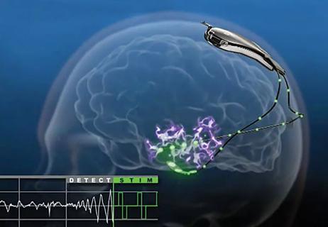RNS Epilepsy brain stimulation illustration
