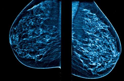 650&#215;450-Breast-Cancer-GettyImages-95290174