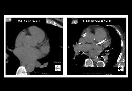 18-CCR-5881-calciumScoreHV-2-650&#215;450