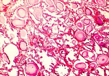 Photomicrograph of prostate hyperplasia