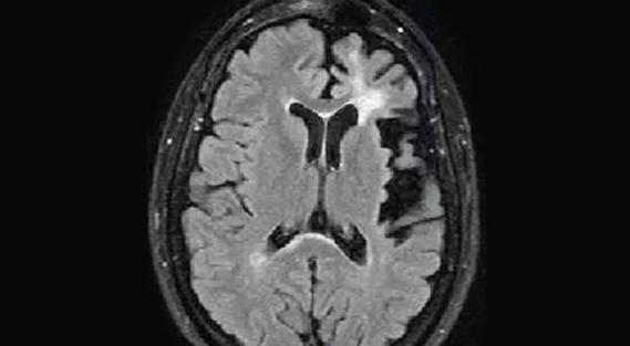 rasmussen encephalitis (RE) - Cleveland Clinic