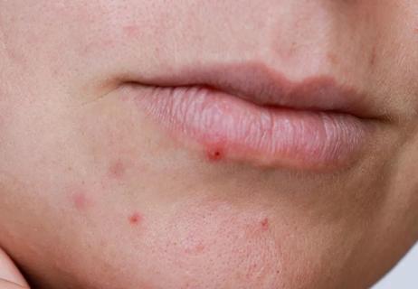 Closeup of pimple on person's lip.