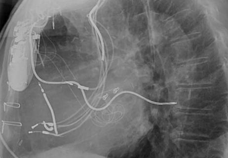 chest X-ray from Dr. Wazni showing abandoned leads.
