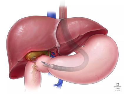 cholecystostomy