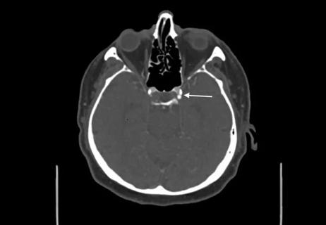 Calcification (arrow) in the intracranial carotid artery of a patient with acute ischemic stroke