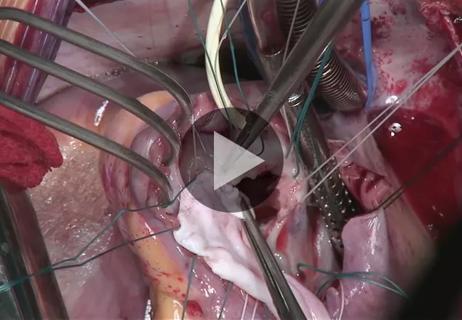 Tricuspid Valve Reconstruction for Infective Endocarditis: Operative Highlights (Video)