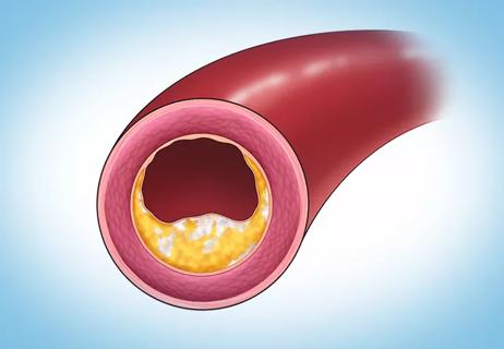 illustration of coronary artery with calcified plaque