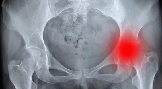 Hip-Arthroplasty-Hero-Image-690x380pxl