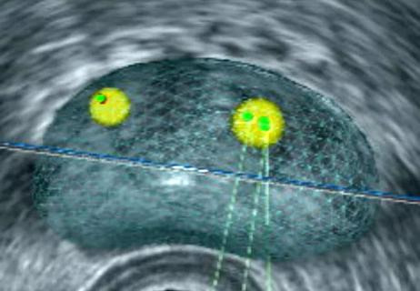 Transperineal Fusion-Guided Biopsy