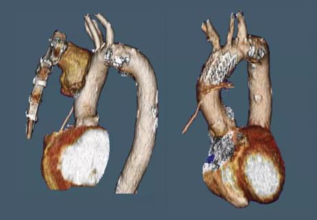 Stent Grafting for an Ascending Aorta Pseudoaneurysm in an 86-Year-Old