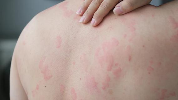 Person reaching hand over shoulder to their back, which is covered in hives